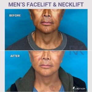 Men's Facelift and Necklift