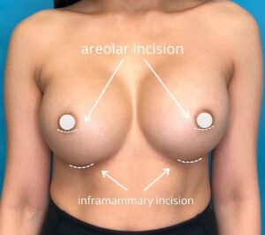 Areolar Incision and Inframammary Incision